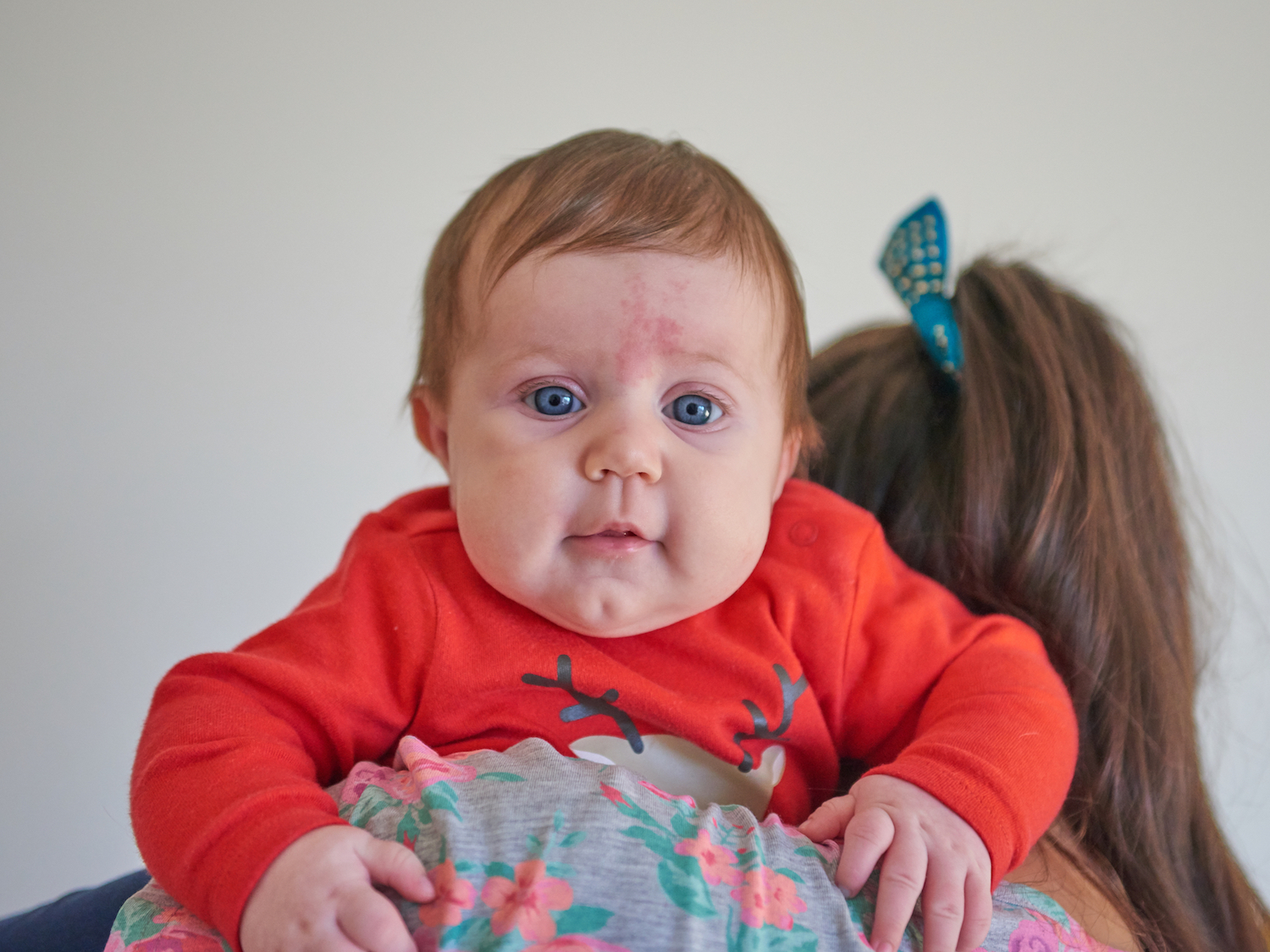 Baby with Birthmark