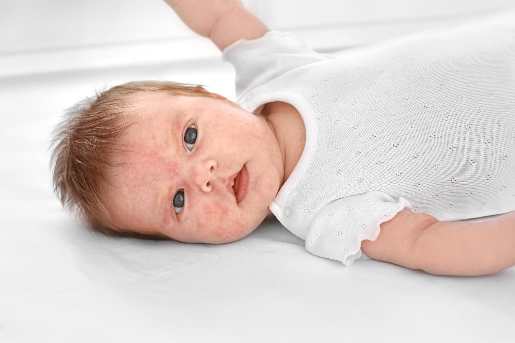 Baby With Allergies Rash
